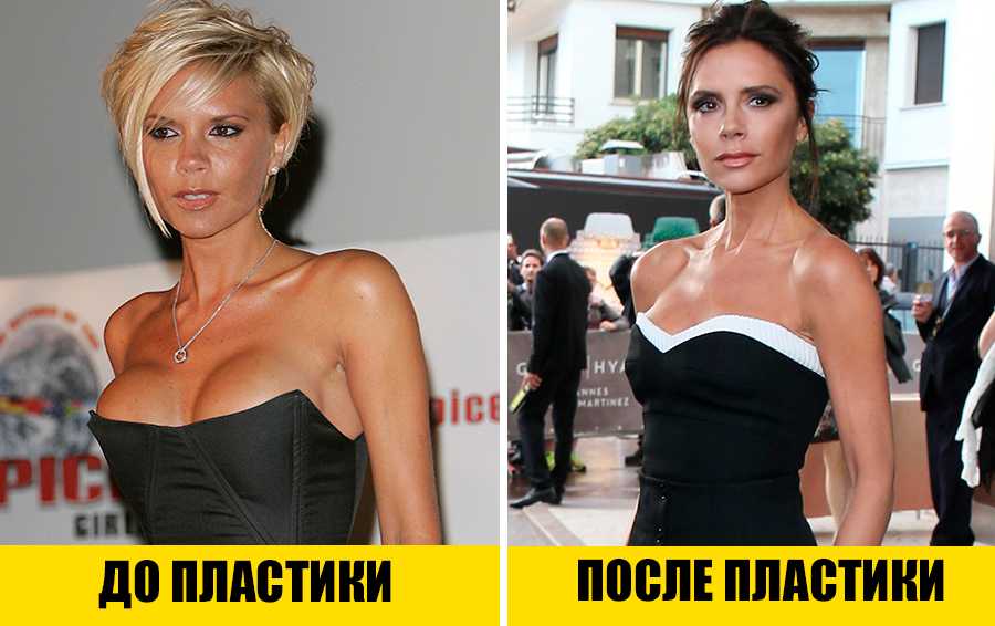 Ринопластика знаменитостей фото до и после операции