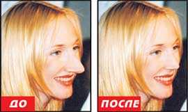 Кристина орбакайте до и после пластики – какую пластику делала звезда (8 видео)