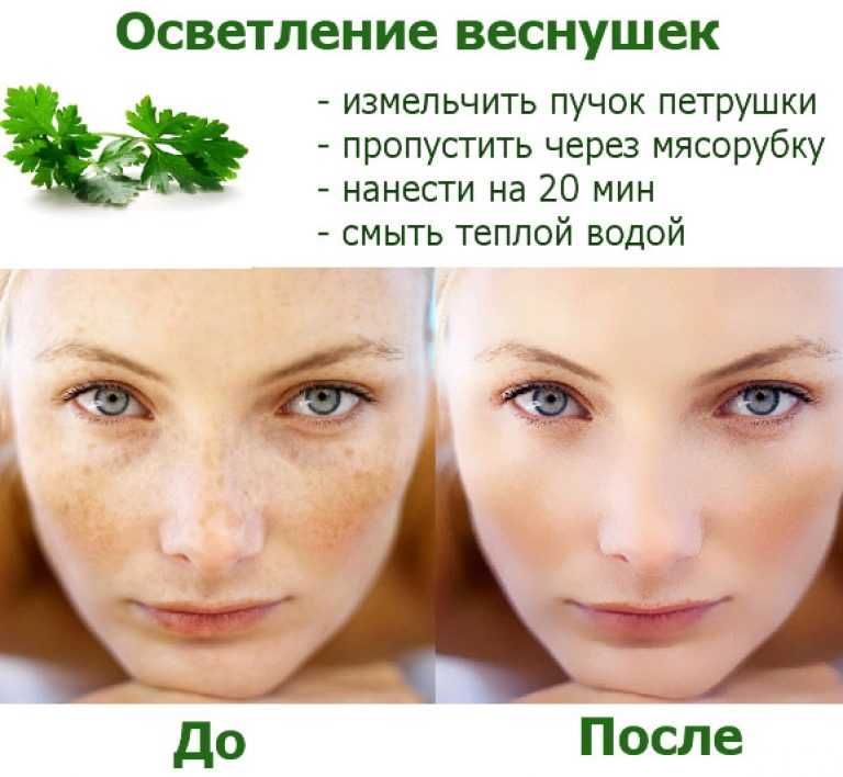 Веснушки: механизм появления, способы устранения, защита кожи