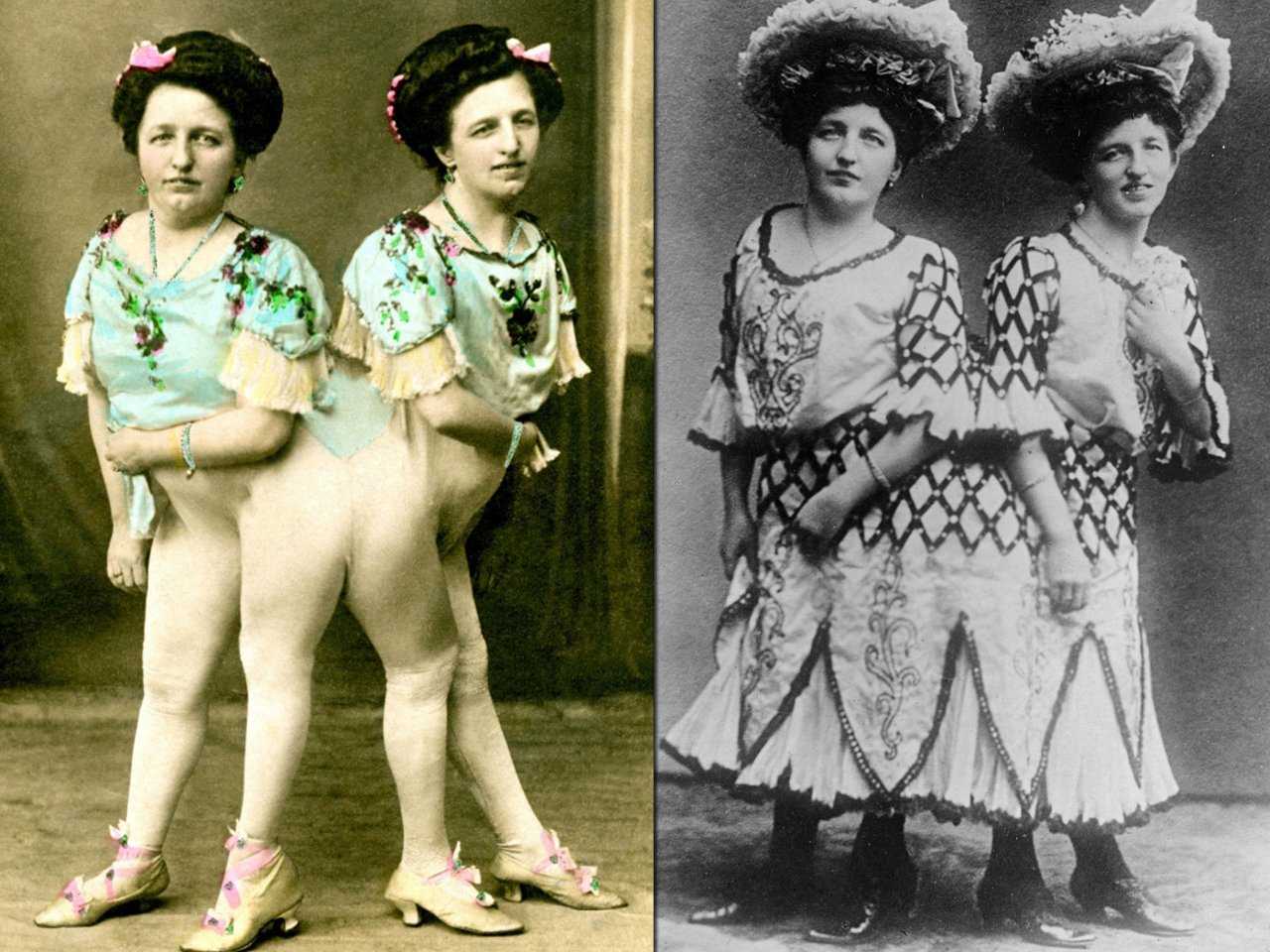 10 удивительных историй самых известных сиамских близнецов (16 фото)