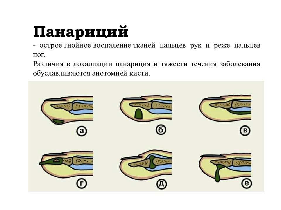 Причины, симптомы и лечение панариция. амбулаторная хирургия во владивостоке