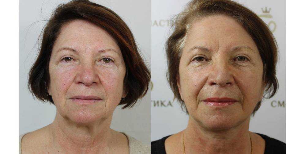Дарья пынзарь до пластики, результаты после для лица | marykay-4u.ru