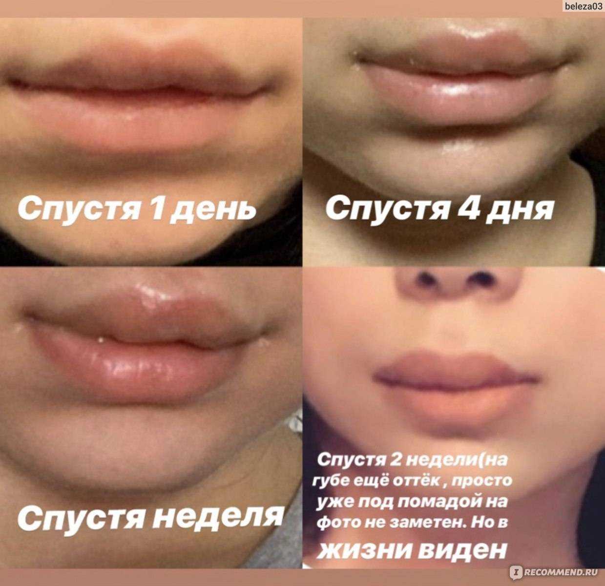 Можно ли увеличивать губы до 18 лет?