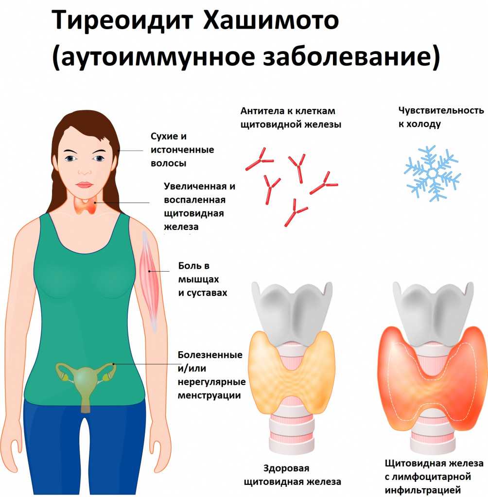 Опыт лечения узлового зоба щитовидной железы корнями лапчатки - здравие - блог захара журавлева