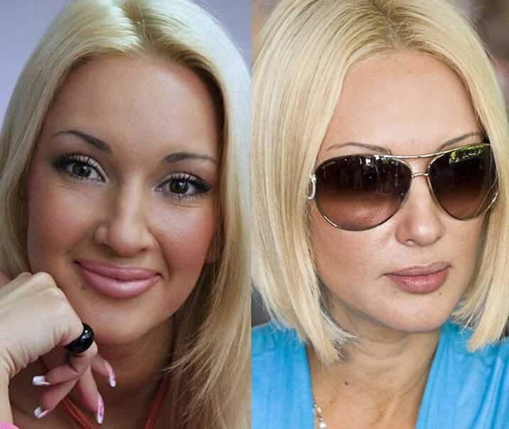 Какую пластика делала лера кудрявцева? +фото до и после пластики +видео