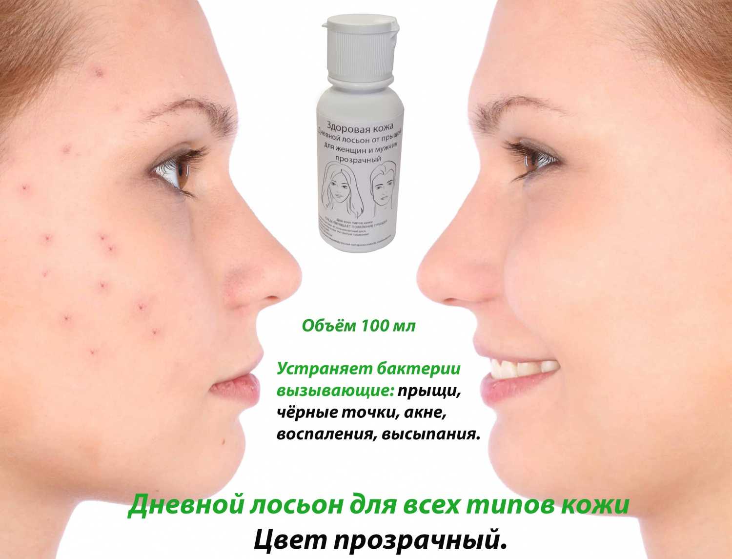 Маски для лица от прыщей и угрей, самые эффективные рецепты