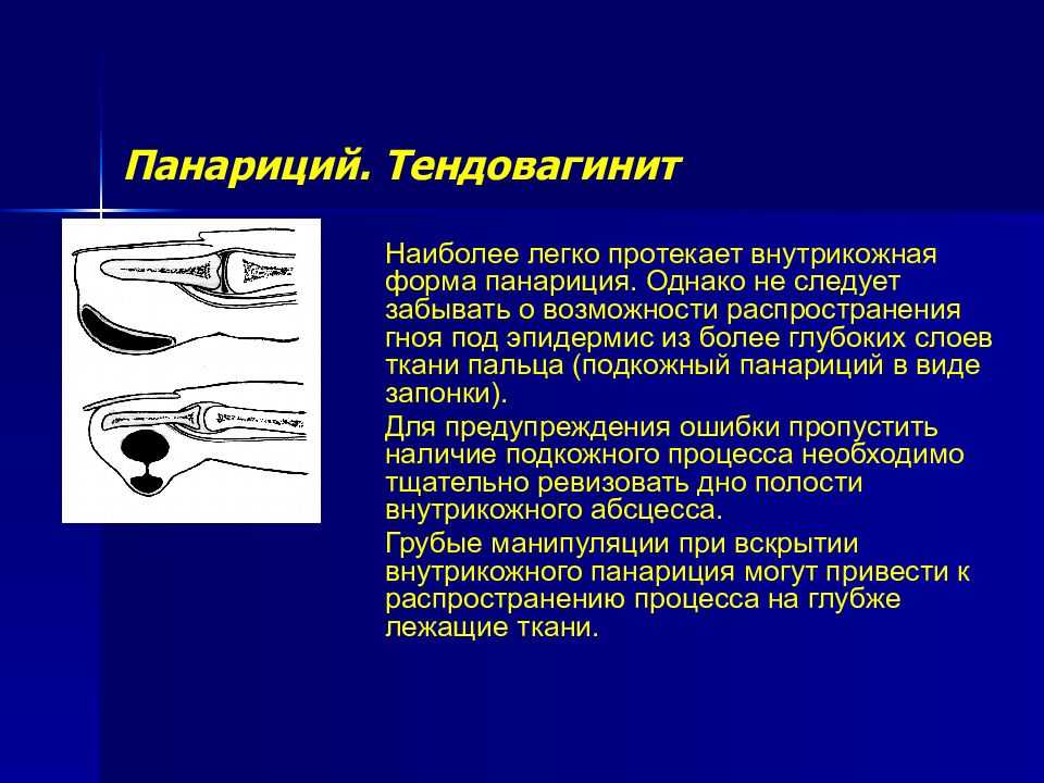 Панариций: виды околоногтевой и иные, диагностика и лечение, классификация, и что это такое и как избавиться от болезни на пальцах ног и рук в домашних условиях?