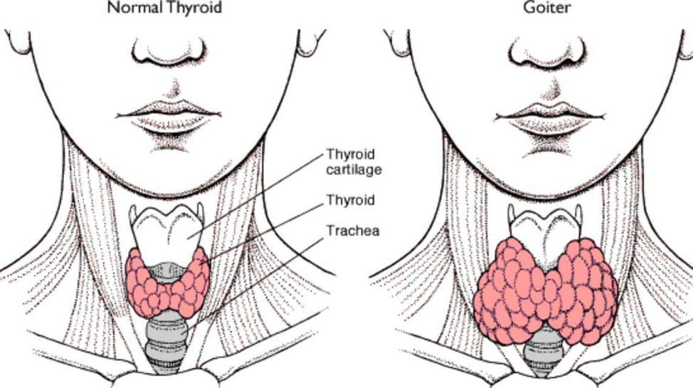 Разрастание тканей эндокринного органа или зоб щитовидной железы: симптомы и лечение народными средствами в домашних условиях