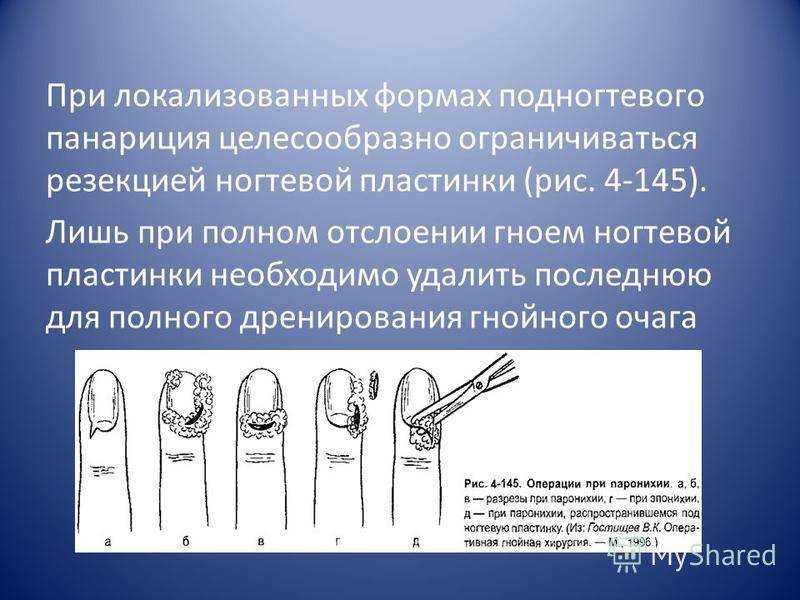 Панариций на пальце: виды, причины, симптомы, лечение в домашних условиях