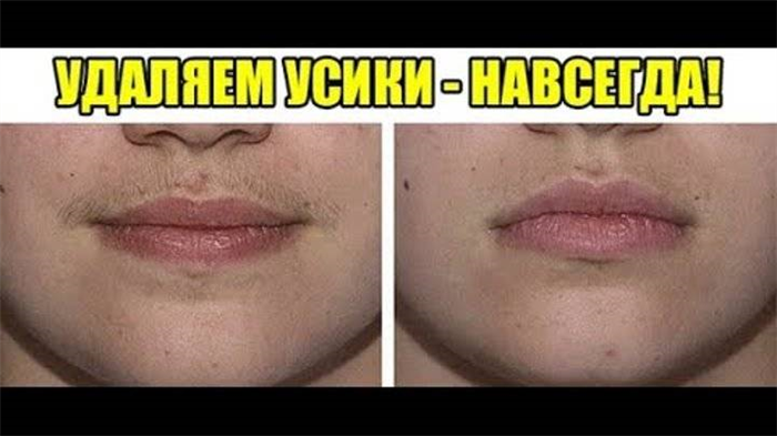 Эпиляция верхней губы: как убрать усики женщине в домашних условиях, можно ли их выщипывать пинцетом и другие способы, отзывы